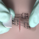 The microMend device being applied. (Image: KitoTech Medical)